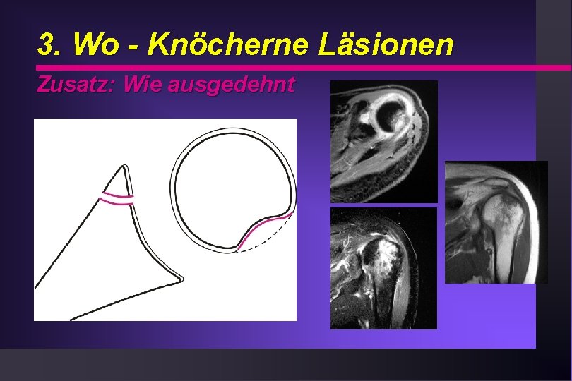 3. Wo - Knöcherne Läsionen Zusatz: Wie ausgedehnt Keyl 1982 