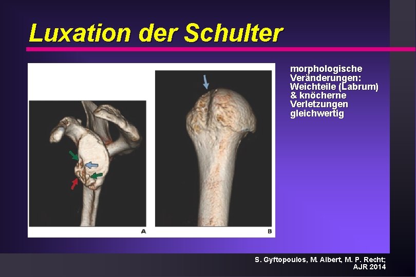 Luxation der Schulter morphologische Veränderungen: Weichteile (Labrum) & knöcherne Verletzungen gleichwertig S. Gyftopoulos, M.