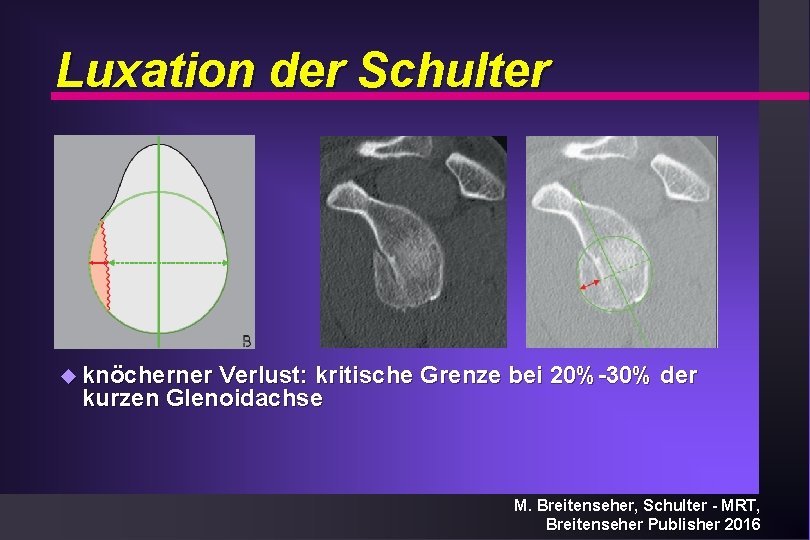 Luxation der Schulter u knöcherner Verlust: kritische Grenze bei 20%-30% der kurzen Glenoidachse M.