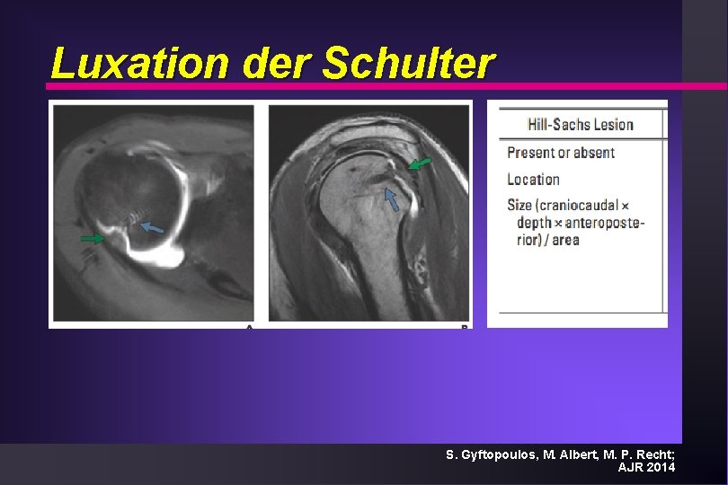 Luxation der Schulter S. Gyftopoulos, M. Albert, M. P. Recht; AJR 2014 