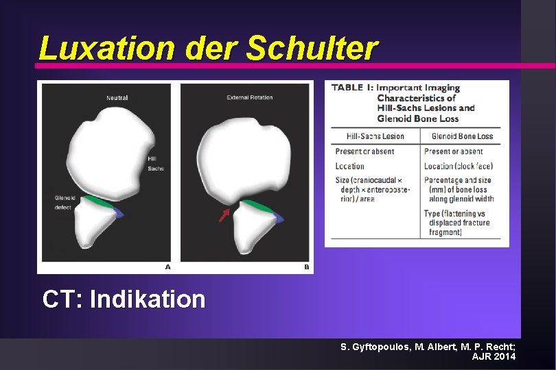 Luxation der Schulter CT: Indikation S. Gyftopoulos, M. Albert, M. P. Recht; AJR 2014