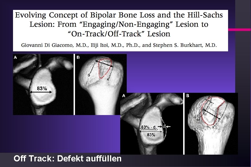 Luxation der Schulter Off Track: Defekt auffüllen 