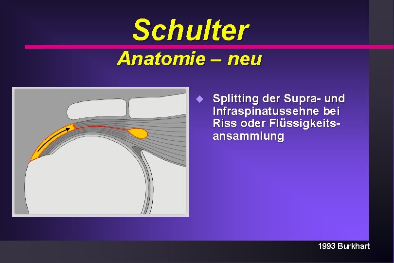 Schulter Anatomie – neu u Splitting der Supra- und Infraspinatussehne bei Riss oder Flüssigkeitsansammlung