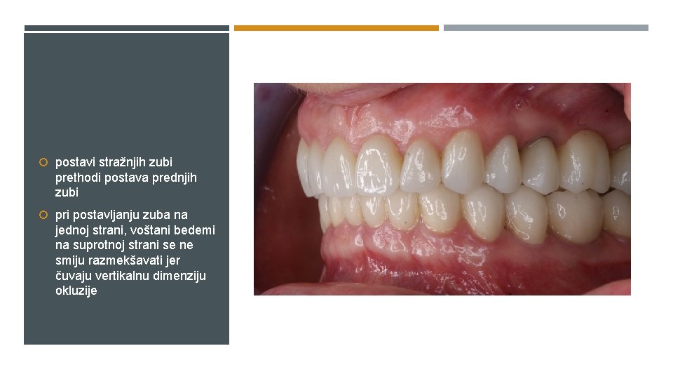 postavi stražnjih zubi prethodi postava prednjih zubi pri postavljanju zuba na jednoj strani,