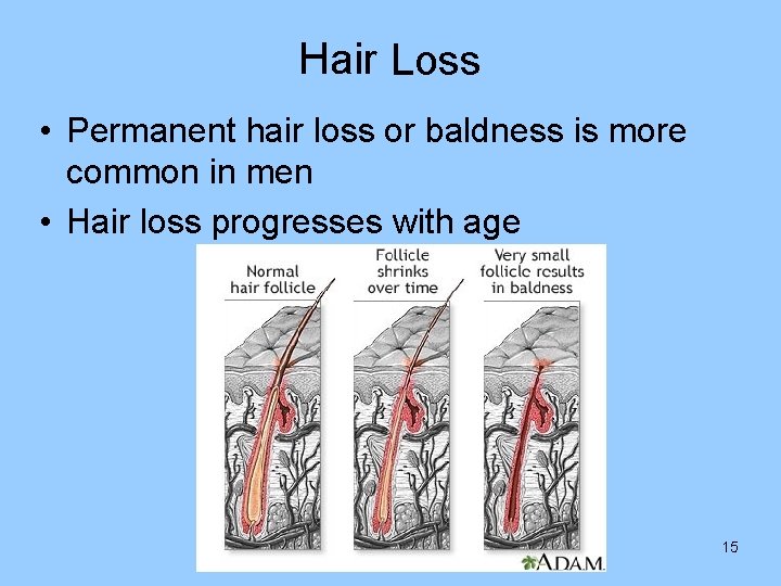 Hair Loss • Permanent hair loss or baldness is more common in men •