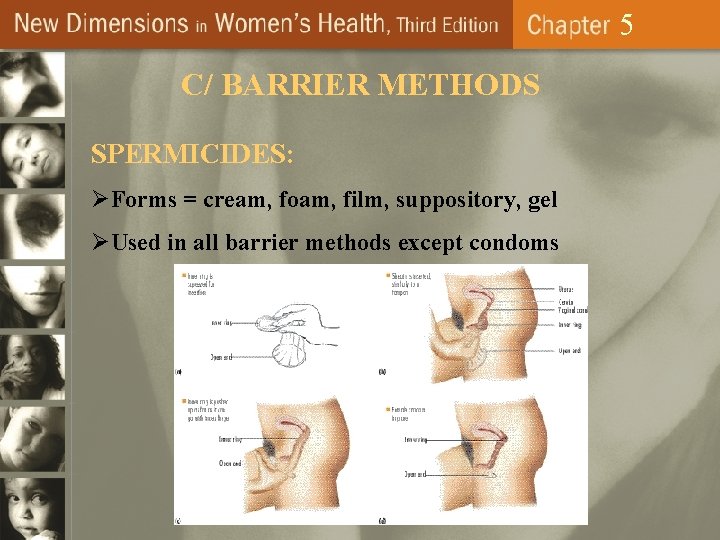 5 C/ BARRIER METHODS SPERMICIDES: ØForms = cream, foam, film, suppository, gel ØUsed in