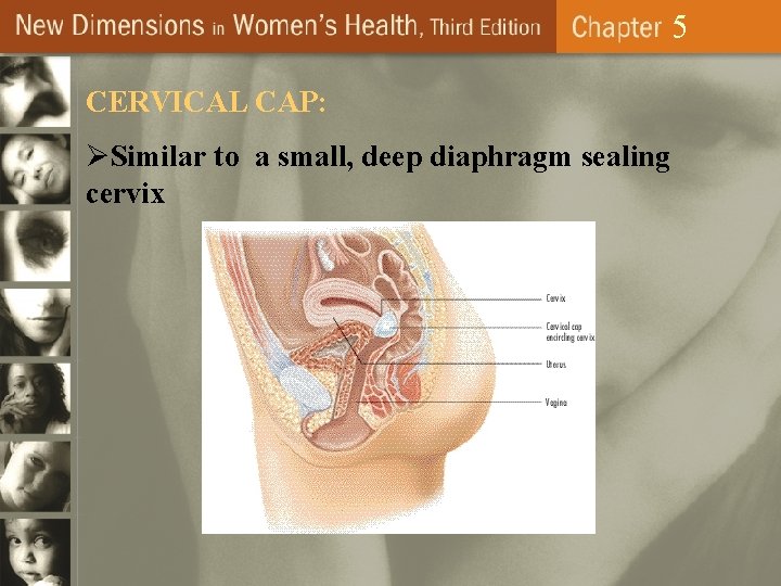 5 CERVICAL CAP: ØSimilar to a small, deep diaphragm sealing cervix 