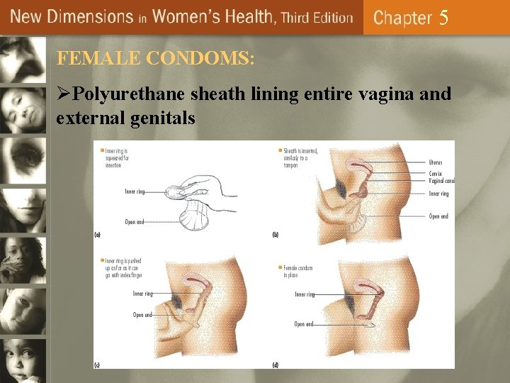 5 FEMALE CONDOMS: ØPolyurethane sheath lining entire vagina and external genitals 