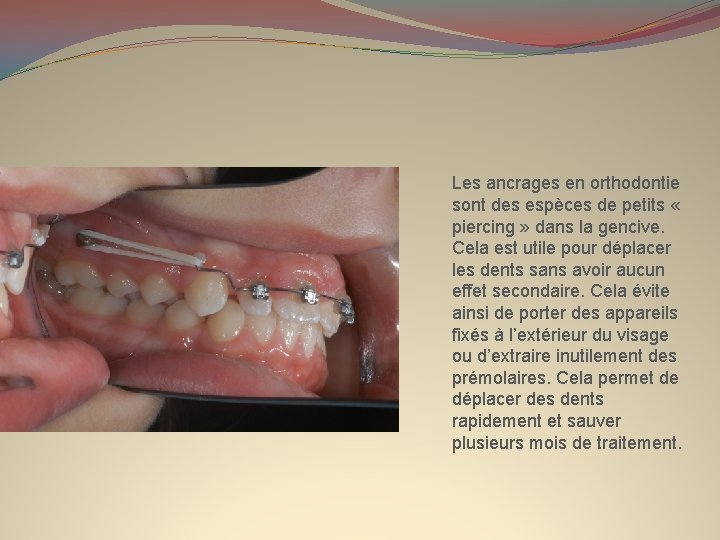 Les ancrages en orthodontie sont des espèces de petits « piercing » dans la