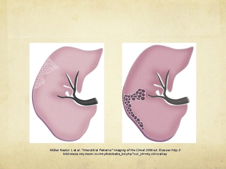 Múller Nestor L et al. “Interstitial Patterns” Imaging of the Chest 2008 ed. Elsevier