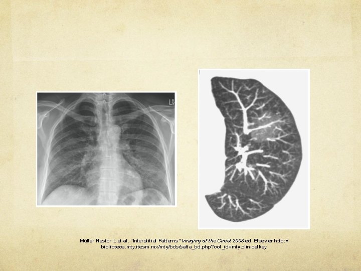 Múller Nestor L et al. “Interstitial Patterns” Imaging of the Chest 2008 ed. Elsevier