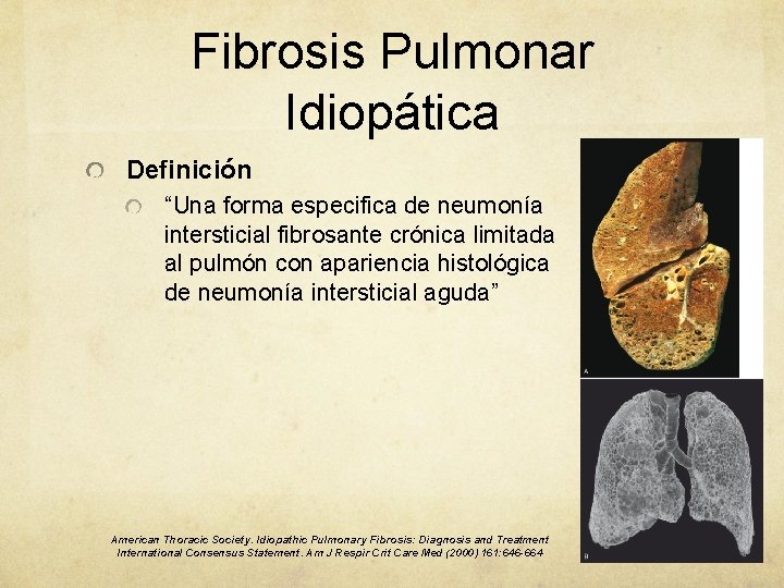 Fibrosis Pulmonar Idiopática Definición “Una forma especifica de neumonía intersticial fibrosante crónica limitada al