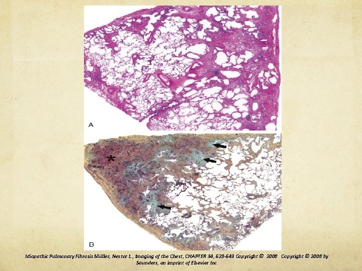 Idiopathic Pulmonary Fibrosis Müller, Nestor L. , Imaging of the Chest, CHAPTER 34, 629