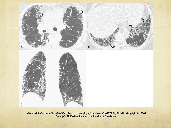 Idiopathic Pulmonary Fibrosis Müller, Nestor L. , Imaging of the Chest, CHAPTER 34, 629