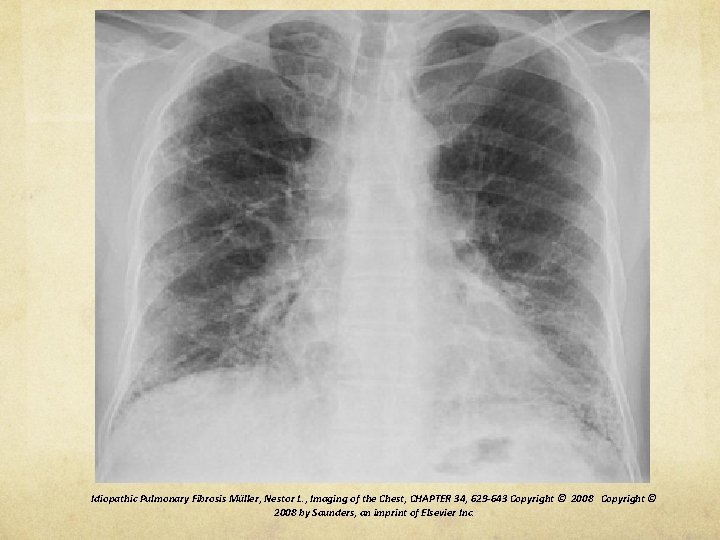 Idiopathic Pulmonary Fibrosis Müller, Nestor L. , Imaging of the Chest, CHAPTER 34, 629