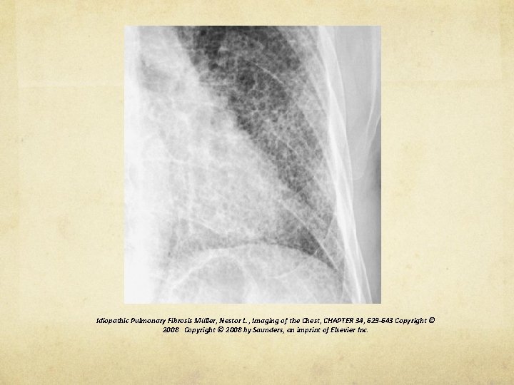 Idiopathic Pulmonary Fibrosis Müller, Nestor L. , Imaging of the Chest, CHAPTER 34, 629