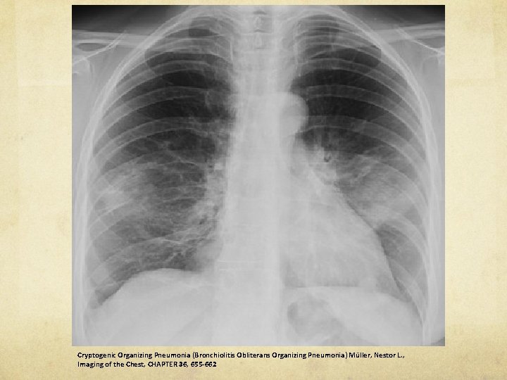 Cryptogenic Organizing Pneumonia (Bronchiolitis Obliterans Organizing Pneumonia) Müller, Nestor L. , Imaging of the