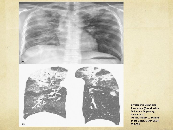 Cryptogenic Organizing Pneumonia (Bronchiolitis Obliterans Organizing Pneumonia) Müller, Nestor L. , Imaging of the