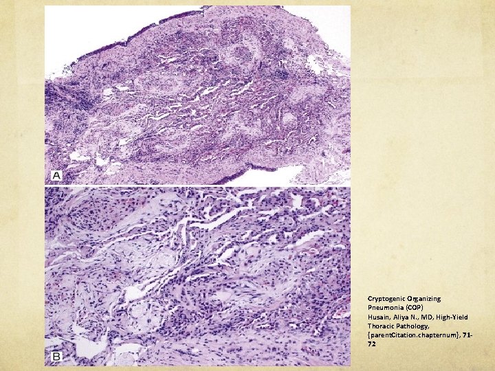 Cryptogenic Organizing Pneumonia (COP) Husain, Aliya N. , MD, High-Yield Thoracic Pathology, {parent. Citation.