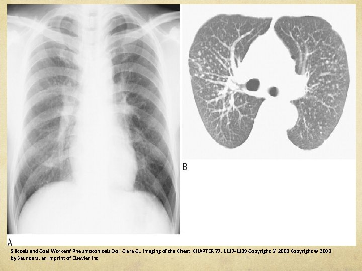 Silicosis and Coal Workers' Pneumoconiosis Ooi, Clara G. , Imaging of the Chest, CHAPTER