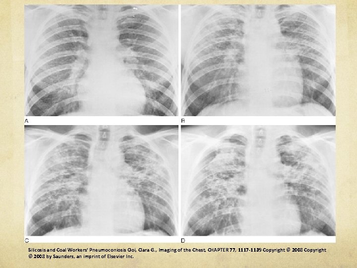 Silicosis and Coal Workers' Pneumoconiosis Ooi, Clara G. , Imaging of the Chest, CHAPTER