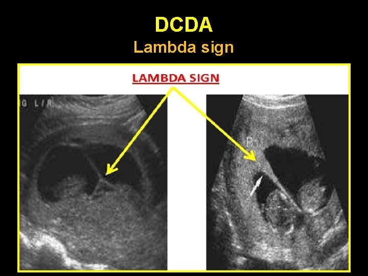DCDA Lambda sign 