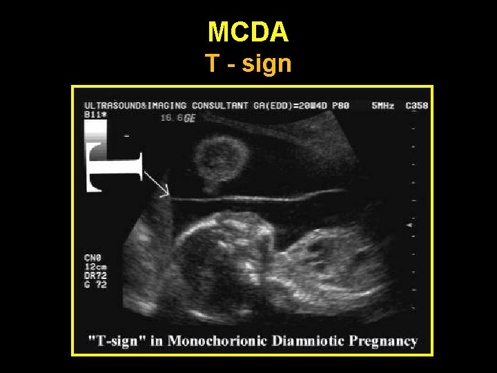 MCDA T - sign 