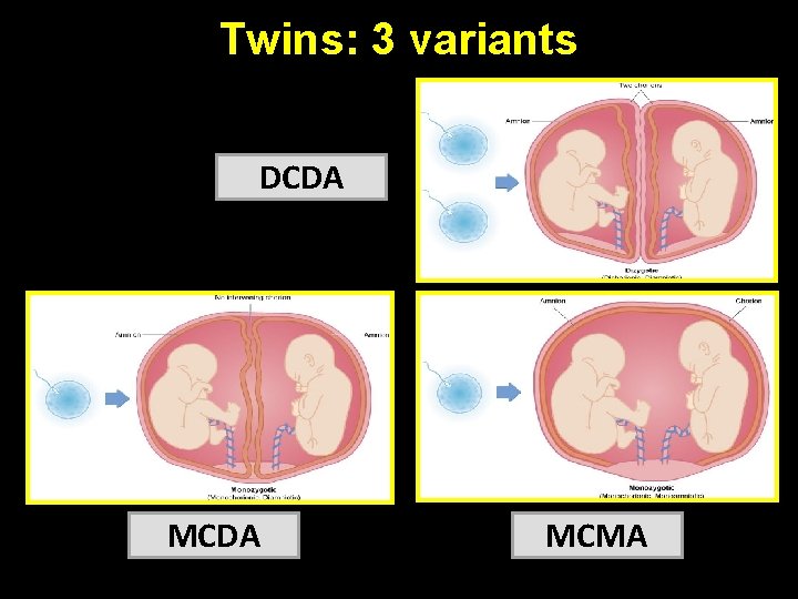 Twins: 3 variants DCDA MCMA 