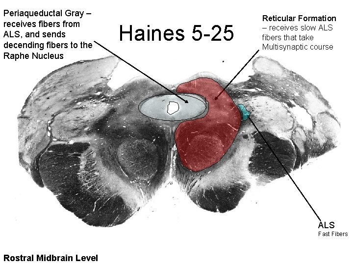 Periaqueductal Gray – receives fibers from ALS, and sends decending fibers to the Raphe