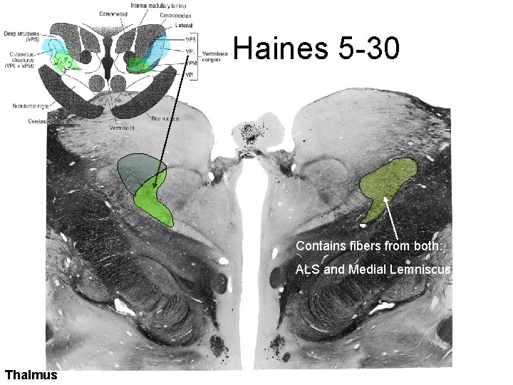 Haines 5 -30 Contains fibers from both: ALS and Medial Lemniscus Thalmus 