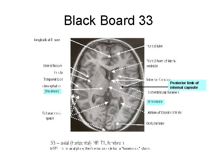 Black Board 33 Posterior limb of internal capsule 