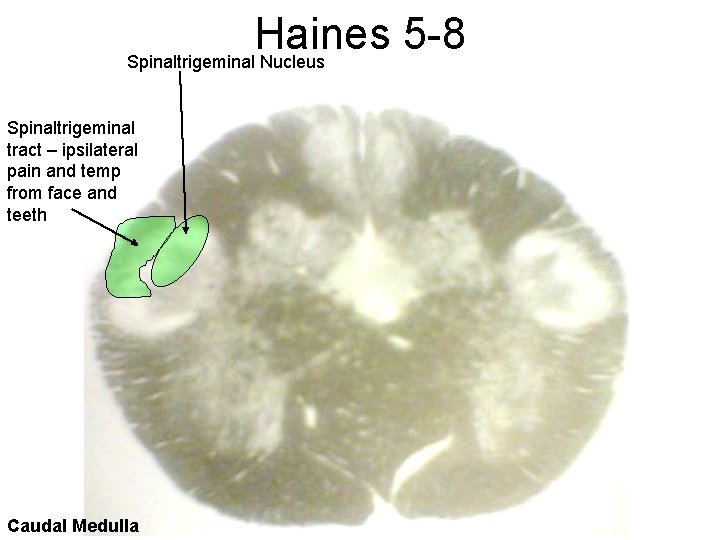 Haines 5 -8 Spinaltrigeminal Nucleus Spinaltrigeminal tract – ipsilateral pain and temp from face