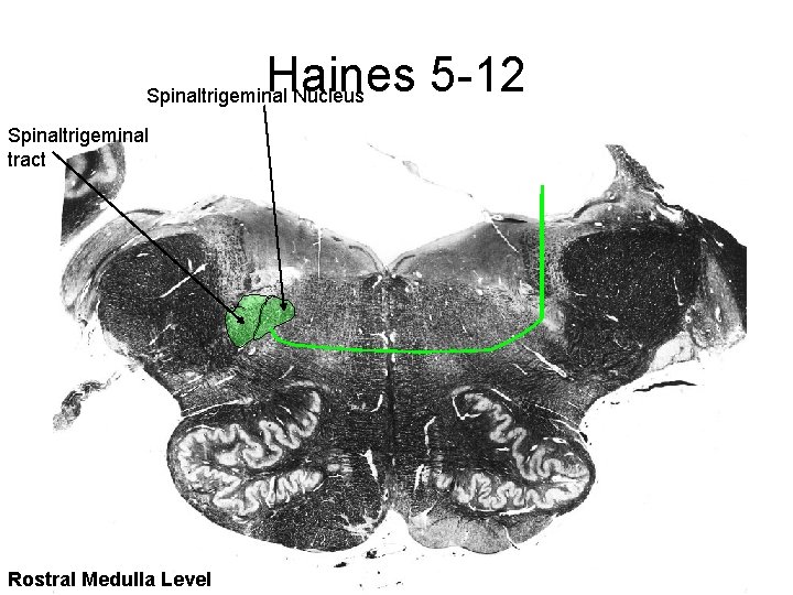 Haines 5 -12 Spinaltrigeminal Nucleus Spinaltrigeminal tract Rostral Medulla Level 