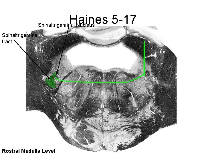 Haines 5 -17 Spinaltrigeminal Nucleus Spinaltrigeminal tract Rostral Medulla Level 