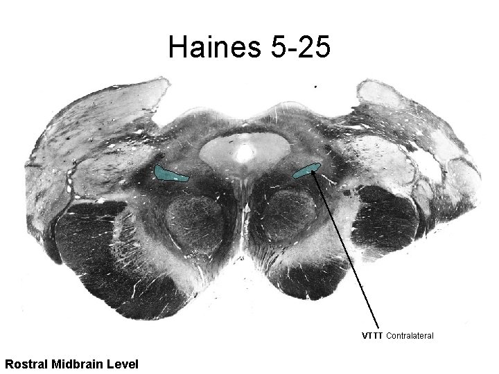 Haines 5 -25 VTTT Contralateral Rostral Midbrain Level 