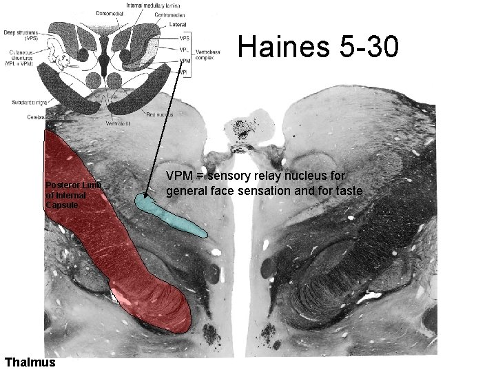 Haines 5 -30 Posteror Limb of Internal Capsule Thalmus VPM = sensory relay nucleus