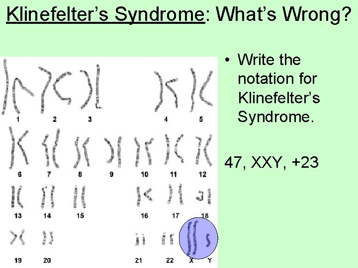 Klinefelter’s Syndrome: What’s Wrong? • Write the notation for Klinefelter’s Syndrome. 47, XXY, +23