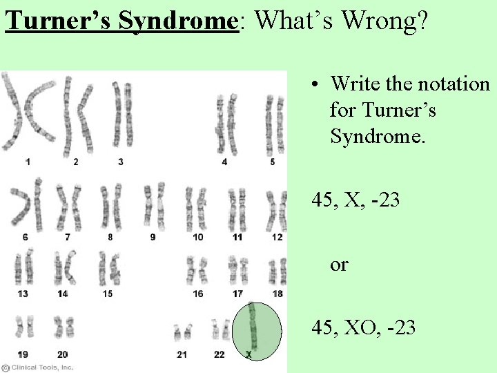 Turner’s Syndrome: What’s Wrong? • Write the notation for Turner’s Syndrome. 45, X, -23