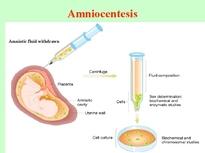Amniocentesis Amniotic fluid withdrawn 