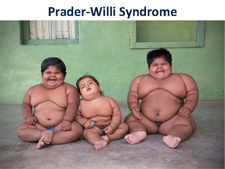 Prader-Willi Syndrome 