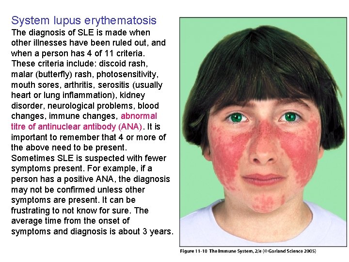 System lupus erythematosis The diagnosis of SLE is made when other illnesses have been