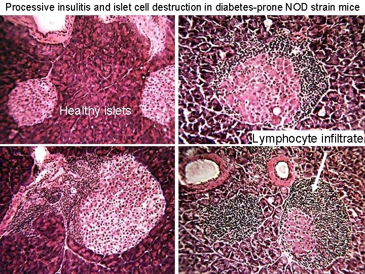 Processive insulitis and islet cell destruction in diabetes-prone NOD strain mice Healthy islets Lymphocyte