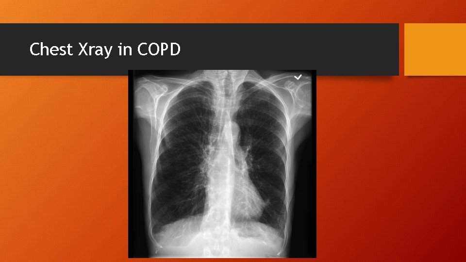 Chest Xray in COPD 