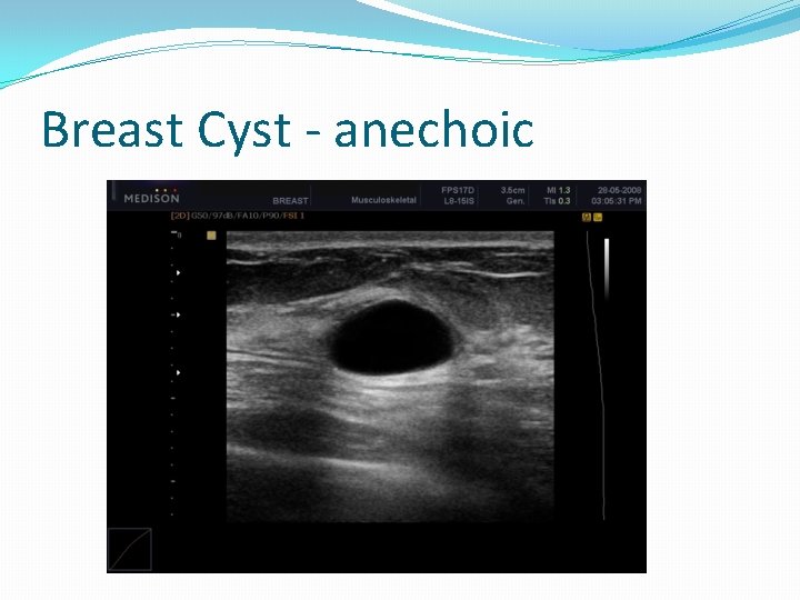 Breast Cyst - anechoic 