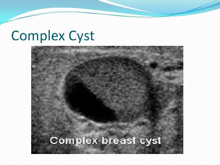 Complex Cyst 