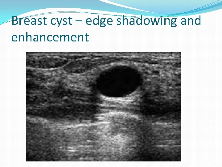 Breast cyst – edge shadowing and enhancement 