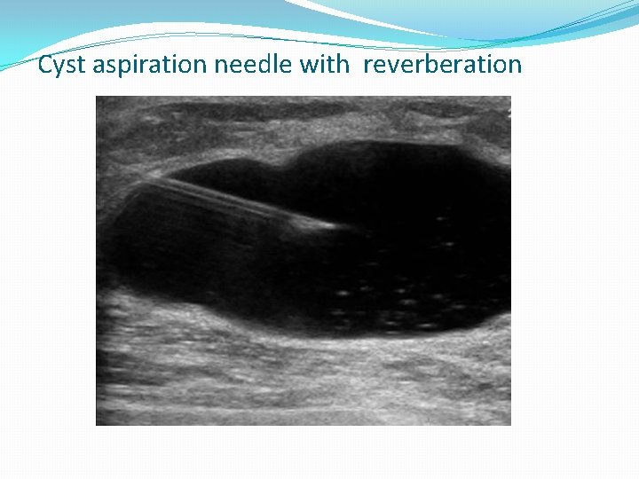 Cyst aspiration needle with reverberation 