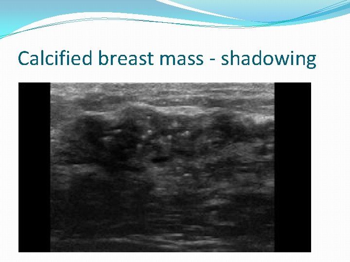 Calcified breast mass - shadowing 