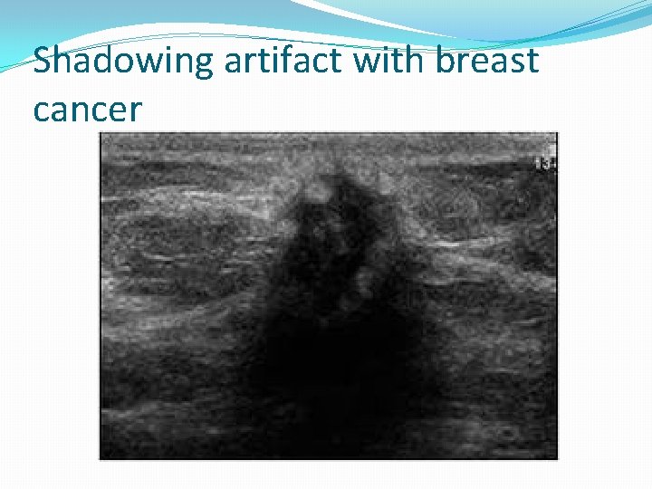 Shadowing artifact with breast cancer 