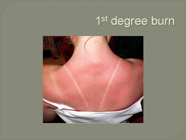 1 st degree burn 